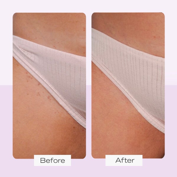 First Aid Beauty Ingrown Hair Treatment Pads (28 Pads) Kostenlose Rückgabe